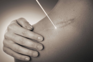 Narben und Falten, Fraxel Laser und PRP (Vampirlifting) Narben und Falten aufgrund von Sonnenschäden und schlaffer Haut behandeln wir individuell auf Sie und ihre Bedürfnisse abgestimmt mittels CO2 Fraxel Laser, PRP (Vampirlifting) und Skin Booster (Hyaluronsäurefiller) in Lindau am Bodensee